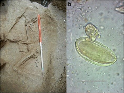 7,000 yıllık kadın iskeletinde kıl kurdu enfeksiyonu